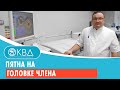 Пятна на головке члена. Клинический случай №104