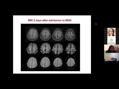 Neurology Grand Rounds: A 65-year-old Woman with a History of Childhood Measles