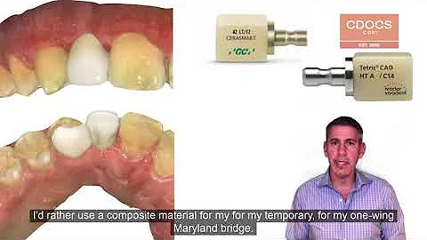 Tip of the Day: One Wing Maryland Bridge