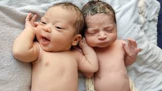 Special Twins Newborn babies with one having Down Syndrome just after birth