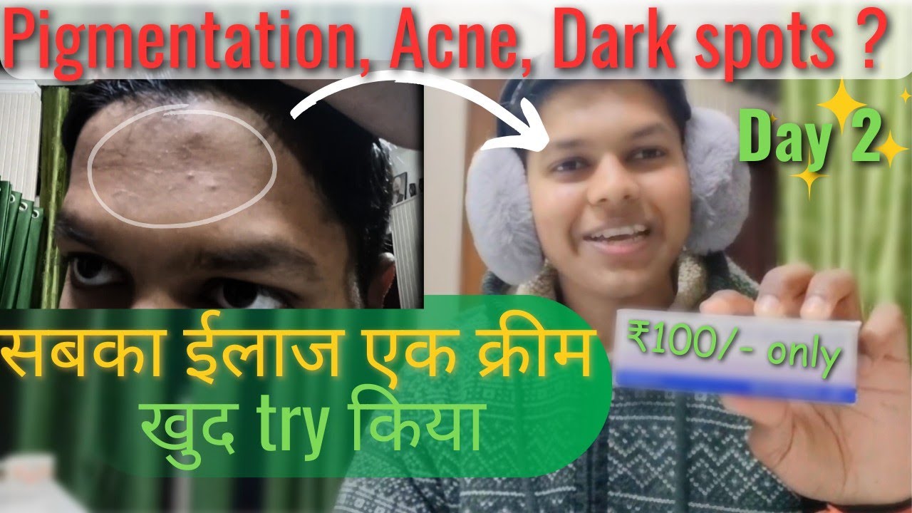 Best Acne Treatment Ever | Dermatologist-Approved Solution | Benzoyl Peroxide