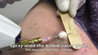 Keloid Cryotherapy