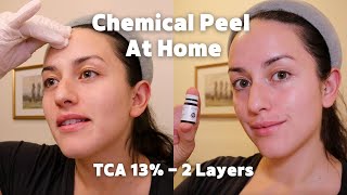 13% TCA At-Home Peel | 2 Layers⎮Day-by-Day Results⎮Before & Afters