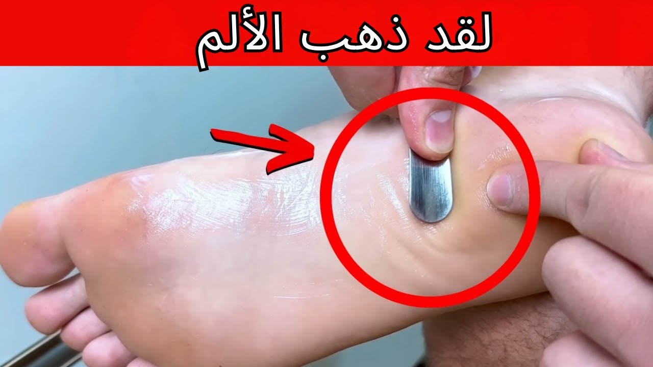 التهاب اللفافة الأخمصية: علاج منزلي فعّال