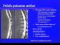 Neuroimaging of Transverse Myelitis: Current and Future