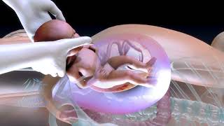Caesarean operation animation