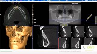 Ct Dent Icat Vision Basic Navigation