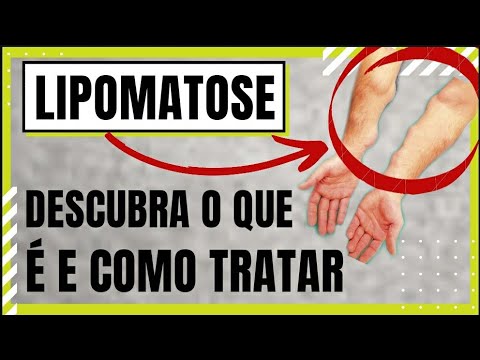 Vídeo: Lipomatose - Tratamento, Lipomatose Hepática E Cutânea