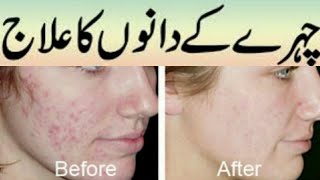 Best lotion for acne prone skin, how to get rid of pimples fast