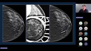 From Screening to Precision Prevention: AI in Breast Cancer Detection and Care (ESIL)