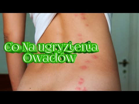 Wideo: Ukąszenia - Leczenie Ukąszeń Alternatywnymi Metodami I środkami