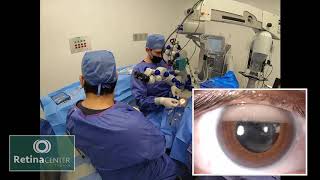 Uso de silicón en cirugías de retina | Cirugía de retina Tijuana México