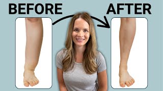 The Best Leg Lymphedema Treatment
