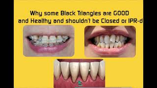 Why IPR isn't always Indicated for Black Triangles and it's good and Healthy to Leave them