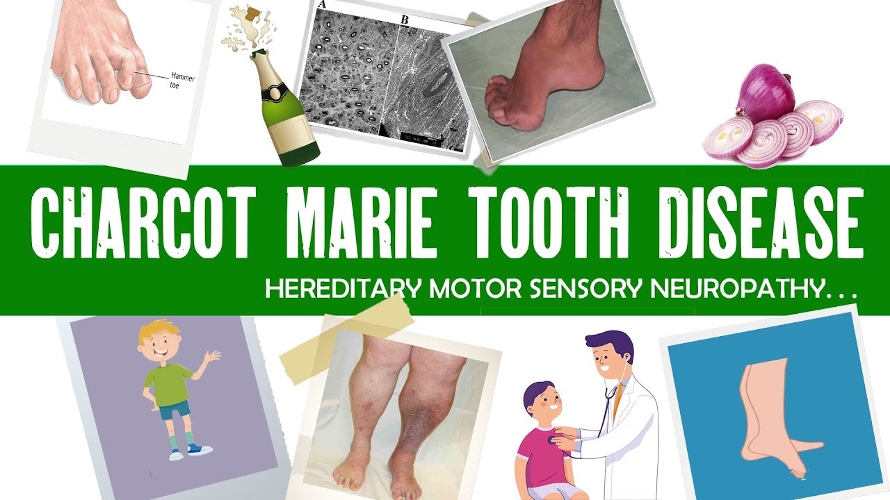 Charcot Marie Tooth Hereditary Neuropathy Market Charcot marie tooth disease | Hereditary motor sensory neuropathy