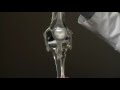 Osteoarthritis of the Knee, Goals for Surgery