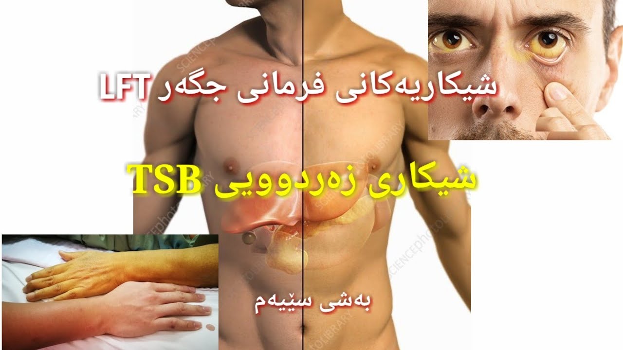 زه ردويي Total Serum Bilirubin ( TSB )