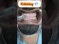Amazing Teeth Cleaning |Tobacco Stains Removal #trending #teeth #viral #shorts #ytshorts #dr