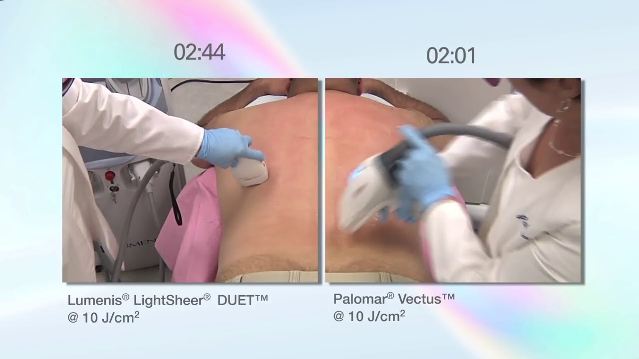 The Palomar Vectus Laser vs  the Lumenis LightSheer Duet