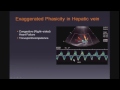 Doppler Ultrasound of the Liver and Portal Hypertension