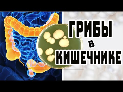 КАК ИЗБАВИТЬСЯ ОТ ГРИБКА КИШЕЧНИКА \\  ПРОФИЛАКТИКА ГРИБКА КИШЕЧНИКА\\  СОВЕТЫ ВРАЧА