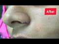 #drvarunnambiar Black Mole Removed Easily | Dr Nambiars | 04985 205525