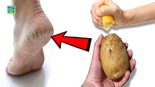 Magic Cracked Heels Home Remedy | Eliminate Cracked Heels And Get White And Smooth Feet