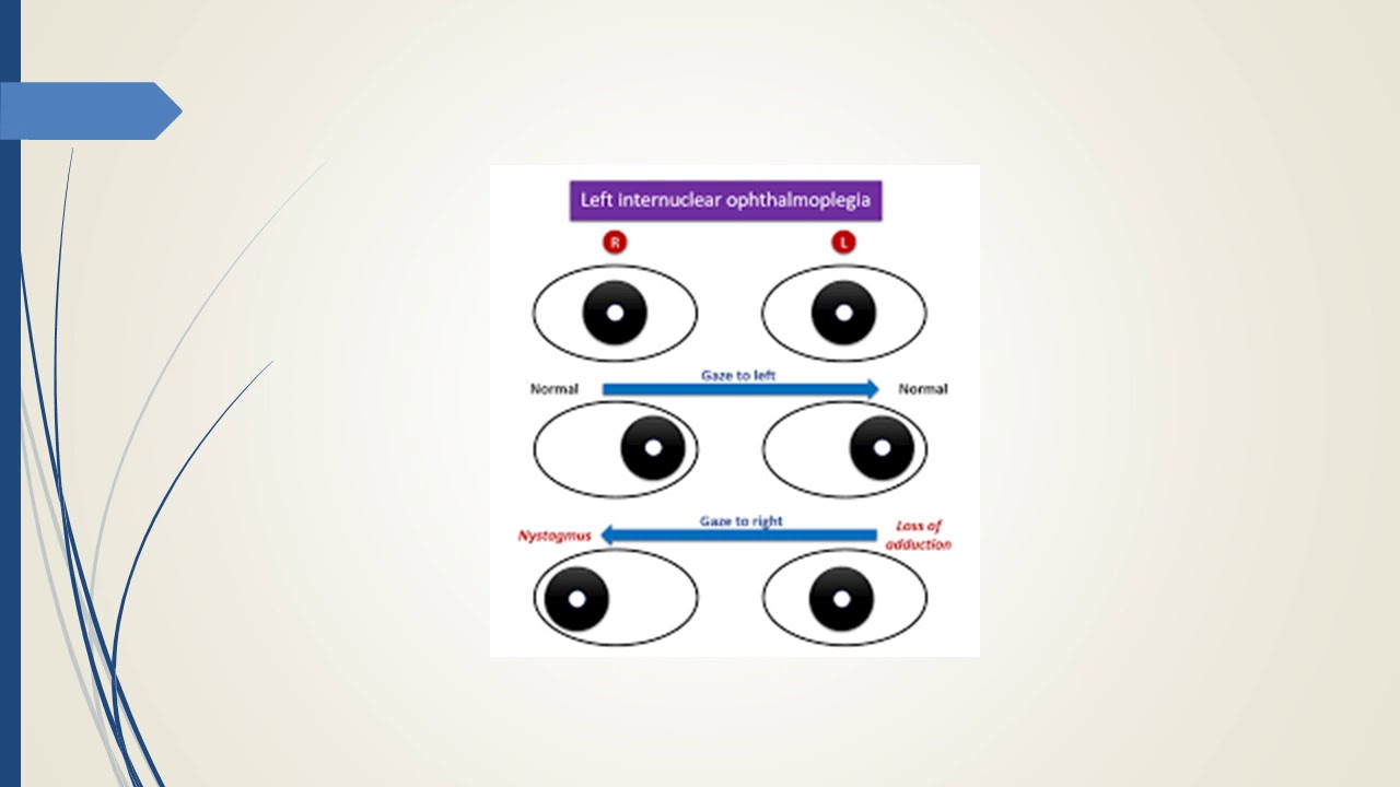 InterNuclear Ophthalmoplegia YouTube