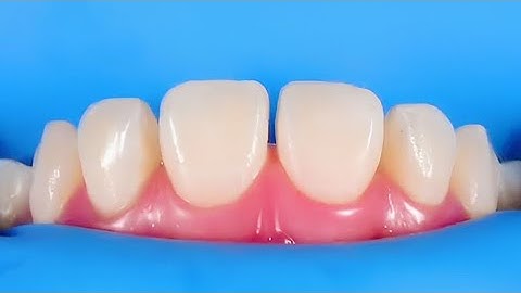 Split dam technique || Rubber dam isolation