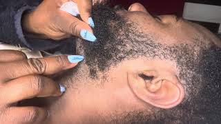 Beards ingrown hair pimple removal