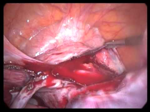 Lap. Assisted Vaginal Hysterectomy LAVH, (unedited)-Abdominal Part-1