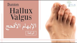 انحراف إصبع القدم الكبير - الإبهام الأفحج     Bunion - Hallux valgus (subtitled)