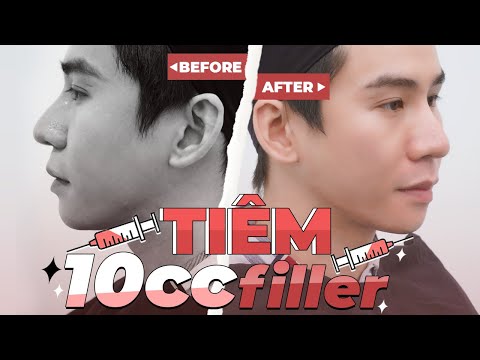 Video KINH NGHIỆM 3 LẦN TIÊM FILLER CỦA MÌNH ( 20CC ) - NGUY... - youtube