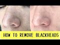 วิธีกำจัดสิวหัวดำที่ดีที่สุด แบบไม่ต้องลอก [ENG] How To Remove Blackheads