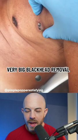 GIANT blackhead removal! #dermreacts #blackheadremoval #acneremoval