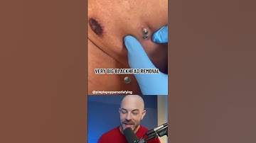 GIANT blackhead removal! #dermreacts #blackheadremoval #acneremoval