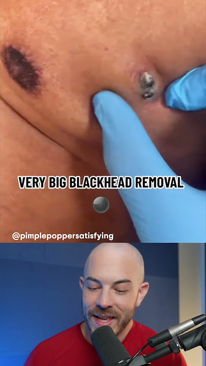GIANT blackhead removal! #dermreacts #blackheadremoval #acneremoval
