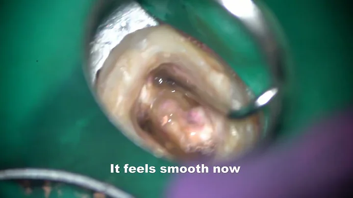 Bypassing an acute-angle ledge in MB with T mode/急な角度のレッジのバイパス法