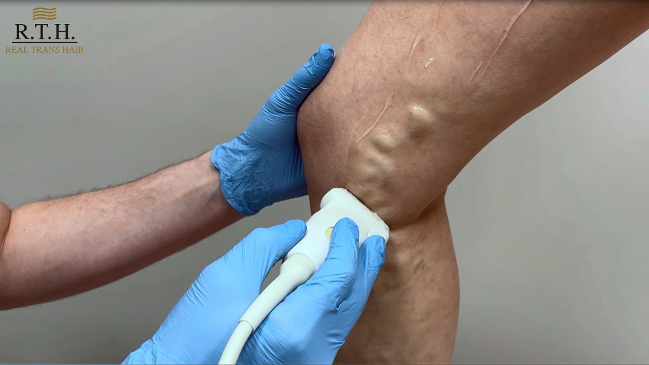 Варикозное расширение вен. Как лечить варикоз? Результат лечения в ...