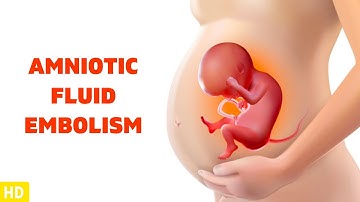 Amniotic Fluid Embolism: The Silent Threat During Childbirth