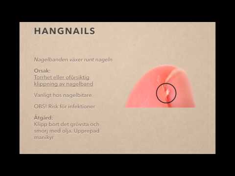 Video: Hyponychium (hud Under Fingernaglar) Förtjockande Orsaker Och Behandling