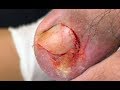 Ouch!  Two deep toenail cutting