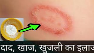 दाद खाज खुजली का घरेलु इलाज || Fungal Infection Ka ilaj || Ringworm Treatment | Khujli & Dad Ka ilaj