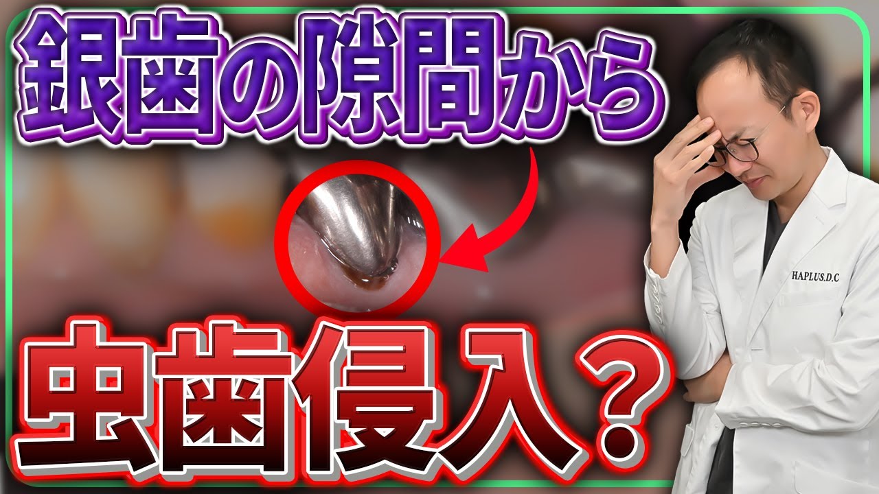 銀歯が入っている人は絶対見て！歯を長く使うための銀歯の適切なケアと替え時について解説させていただきます