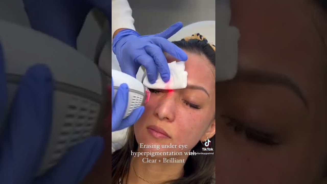 Erasing under eye pigmentation 