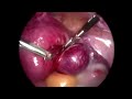Cornual Ectopic Pregnancy: Let the pictures do the talking