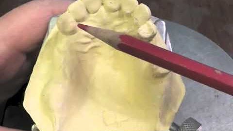 R P D Design - Ken Class II Max Cast #4 Part A