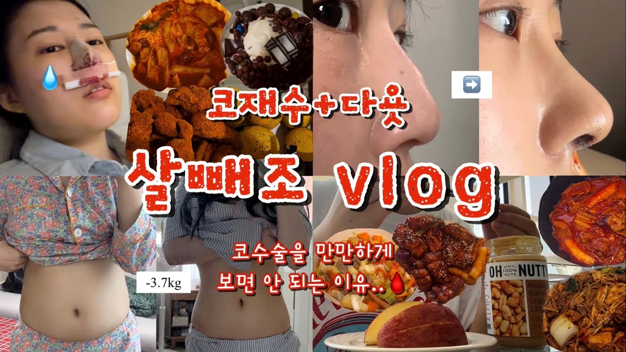 결국 부작용 와서 코 재수술함..😇 홍콩 가기 전 일주일 벼락 다이어트까지⚡️바쁘다 바빠 현대사회💦