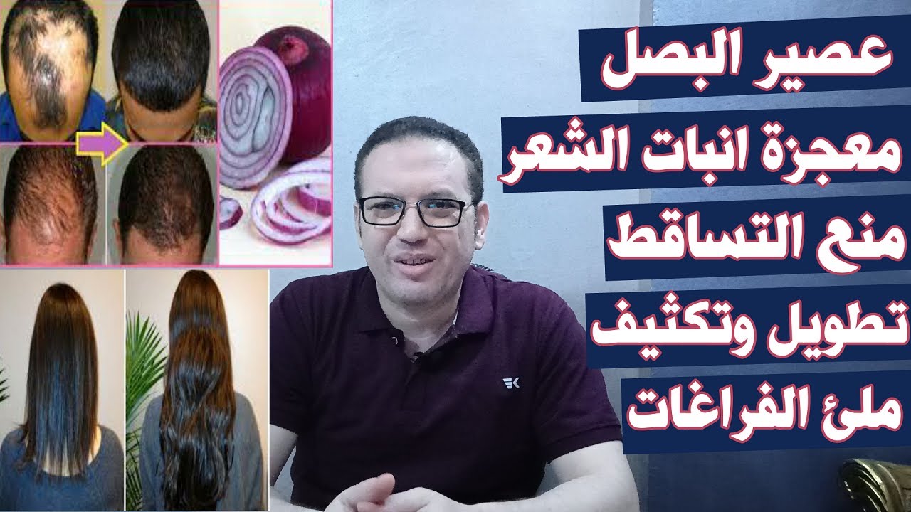 عصير البصل معجزة انبات الشعر ومنع التساقط وتطويل وتكثيف وملئ الفراغات/علاج التساقط والصلع والثعلبه