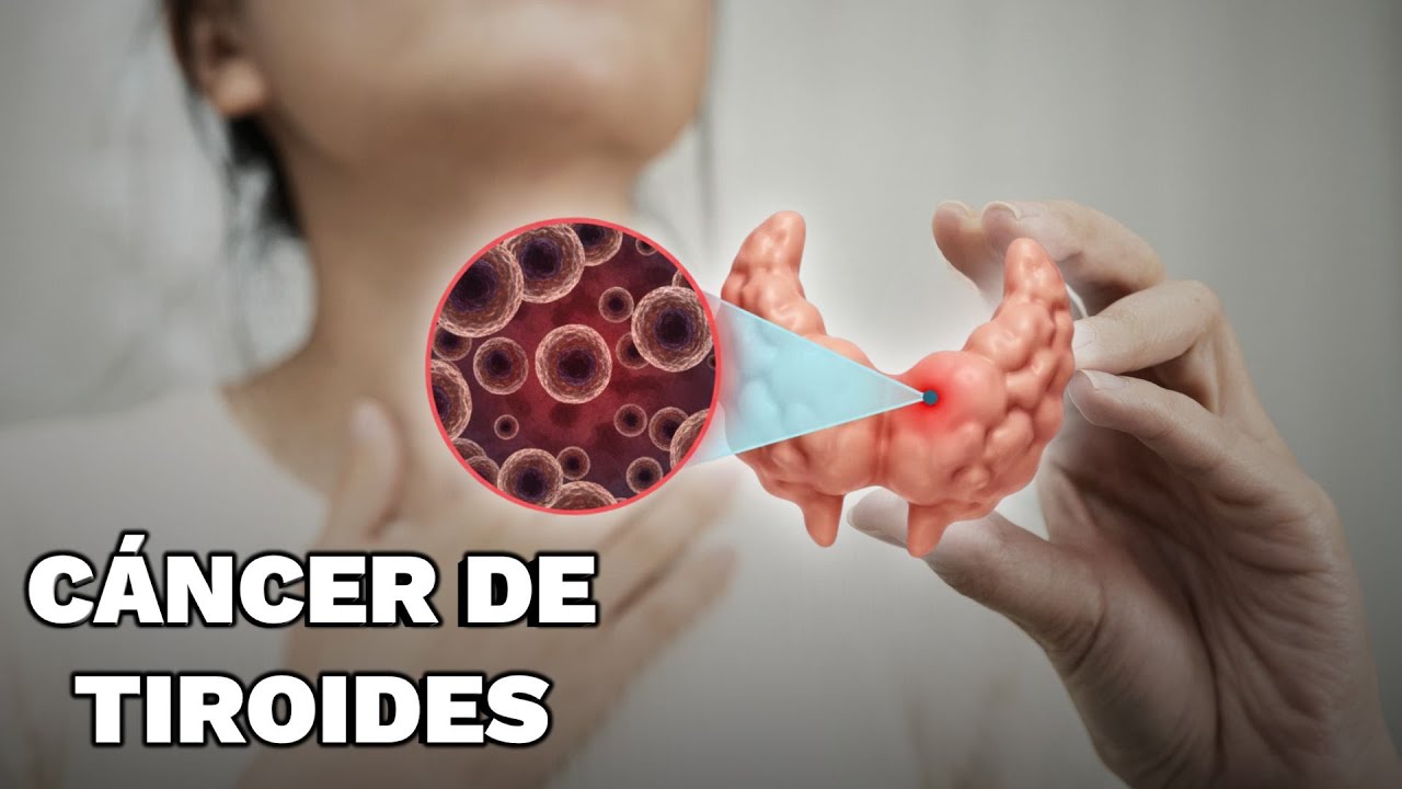CÁNCER de TIROIDES | SÍNTOMAS, CAUSA y TRATAMIENTO